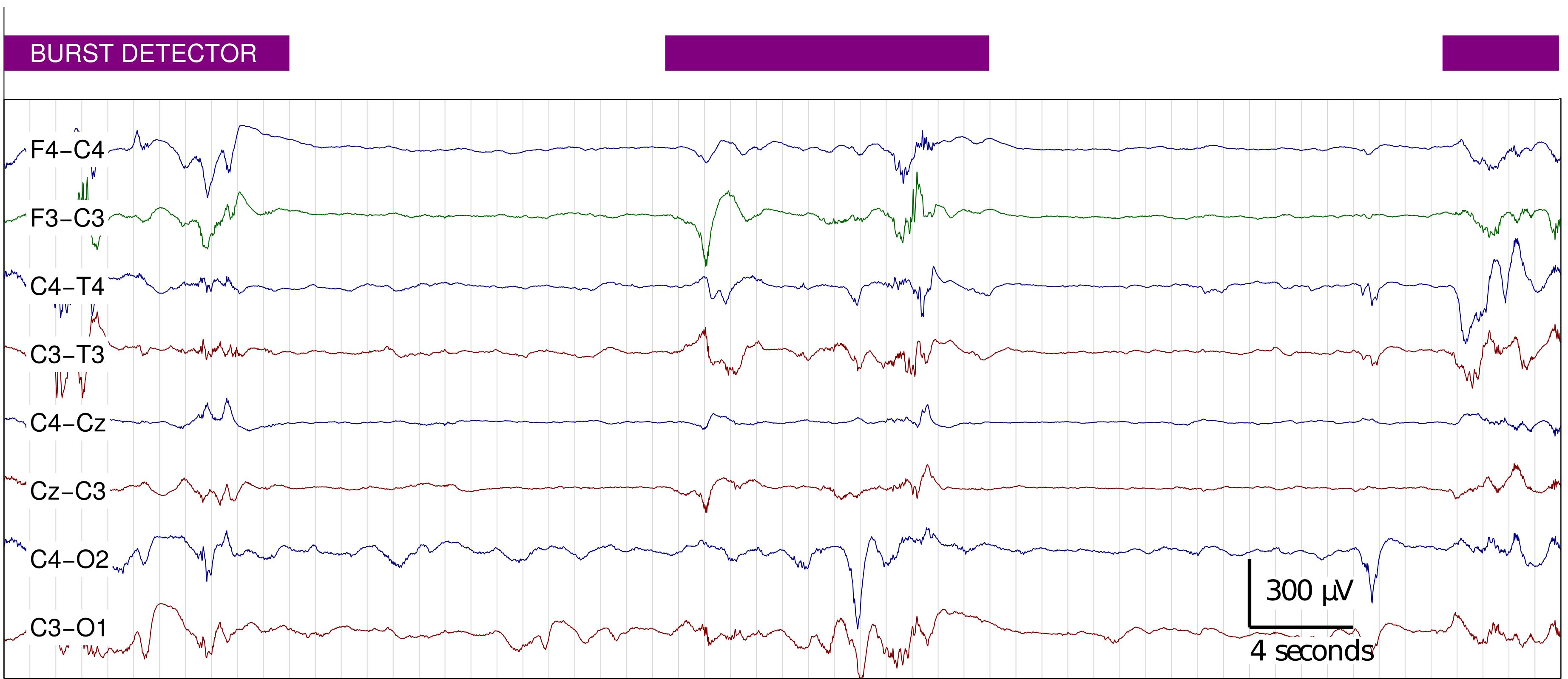 burst detector example